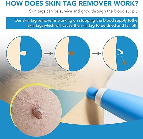 Acrochordon Skin Remover Kit – Safe & Effective Skin Tag Removal