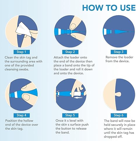 Acrochordon Skin Remover Kit – Safe & Effective Skin Tag Removal